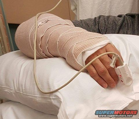 1996 Ford Bronco - A person's arm is heavily bandaged and resting on a pillow. A pulse oximeter is attached to one of the fingers.