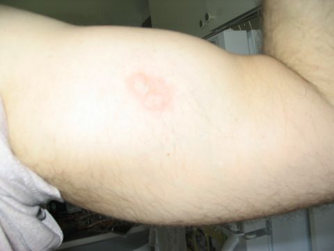 1986 Ford Bronco - A close-up view of a human arm displaying a red, circular rash on the bicep.