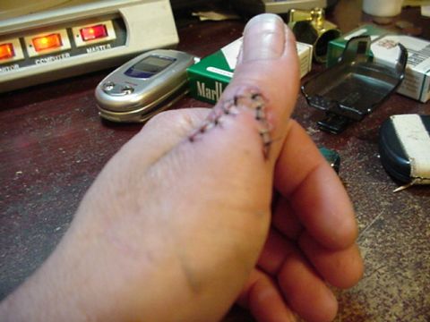 1993 Ford Bronco - A close-up shows a thumb with surgical sutures, surrounded by everyday objects on a cluttered desk.