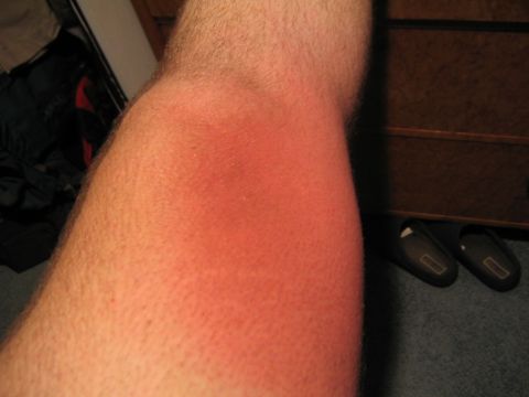 1978 Ford Bronco - Close-up of a person's arm or leg showing a reddened, inflamed patch of skin, likely an irritation or reaction, photographed indoors near a…