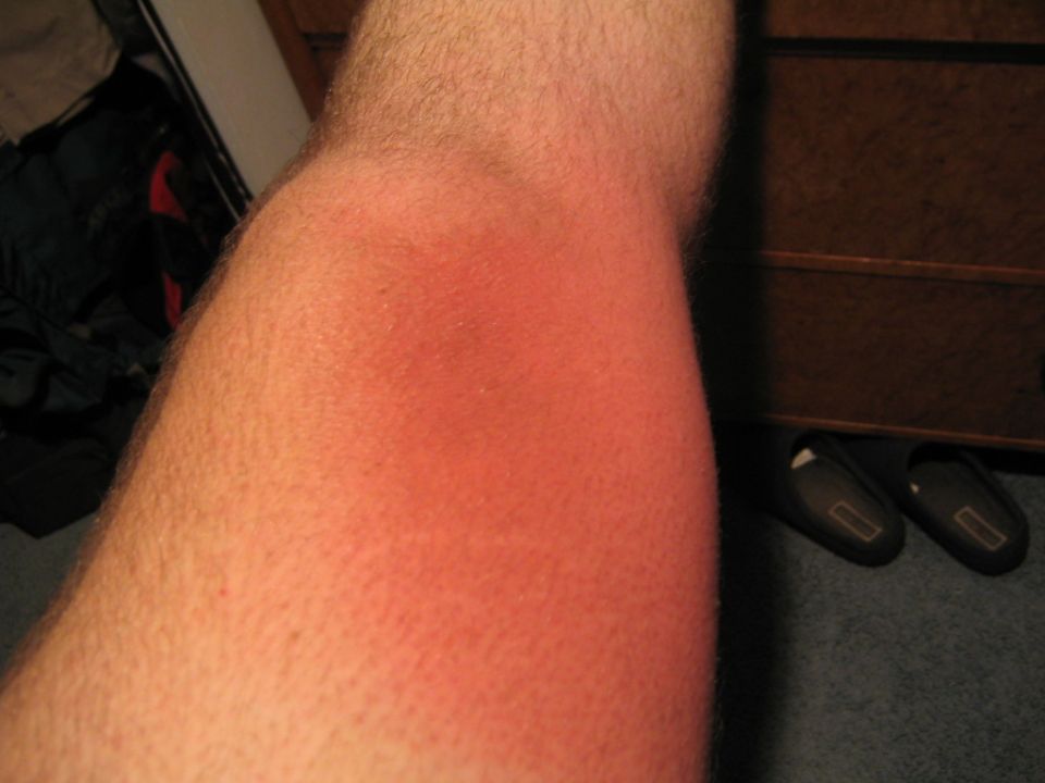 Close-up of a human limb with a red, inflamed skin patch
