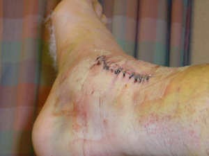 1993 Ford Bronco - A close-up of a stitched wound on a leg, with the SuperMotors logo visible in the lower right corner.