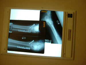 1993 Ford Bronco - X-rays show a surgically repaired arm with hardware installed.