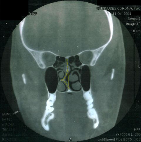 1983 Ford Bronco - The most-deviated septum my doctor has ever seen. It should run straight, but it's pushed over to the L in the pic (my R).