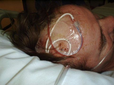 1997 Ford Taurus - A close-up view of a person's head with medical tubes and stitches, indicating a medical situation.