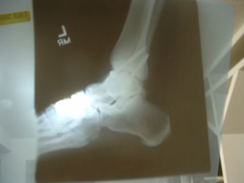 1993 Ford Bronco - My 2004 foot surgery. I got 3 screws in my ankle