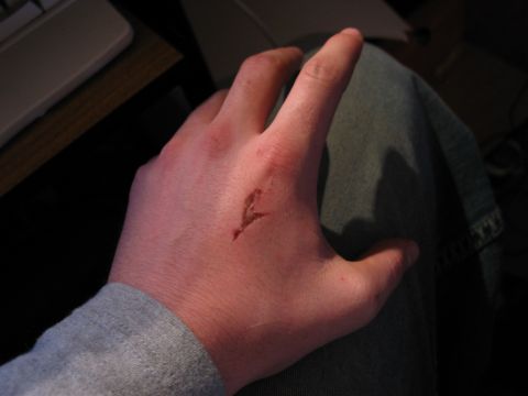 1995 Ford Bronco - A close-up view of a cut on a person's hand, showing the abrasion and minor bleeding.