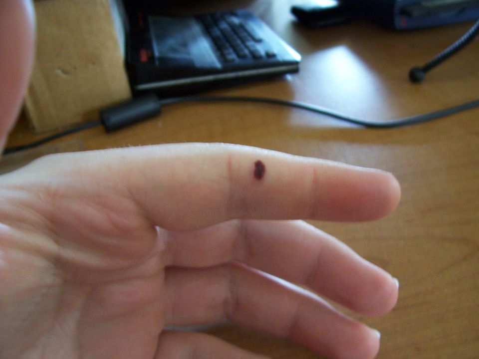 Human finger with a dark mark on it. Supermotors logo visible
