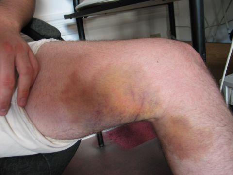 1995 Ford Bronco - A close-up view of a person's leg showing significant bruising.
