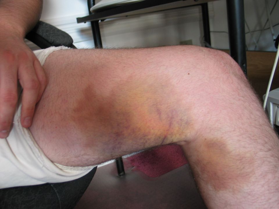 Bruised leg with purple and yellow discoloration
