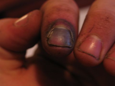 1995 Ford Bronco - A severely bruised fingernail shows discoloration and dirt accumulation around the nail bed.