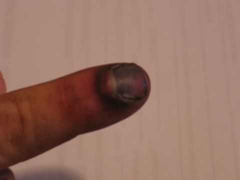 1995 Ford Bronco - A finger shows significant bruising around the nail, indicating a possible injury.