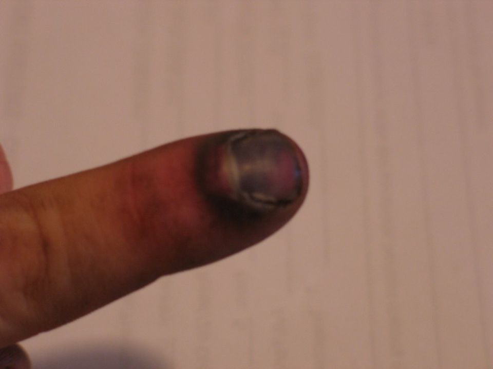 Close-up of a finger with a bruised, blackened nail