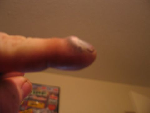 1995 Ford Bronco - A close-up view of a finger, showing a bruised fingernail against a blurred background.