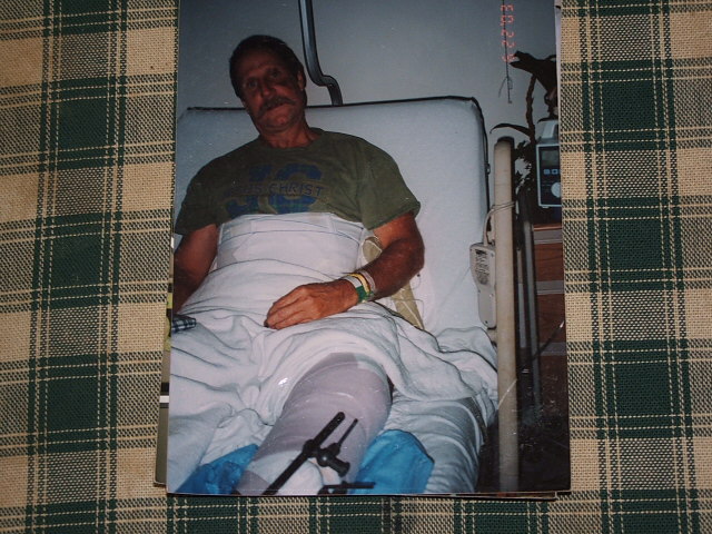 Man in hospital bed with a cast on his leg and bandages around his torso