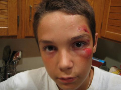 1994 Ford Bronco - A young boy displays facial injuries, including a swollen eye and cuts on his forehead.