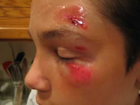 1994 Ford Bronco - Close-up of a person's face showing injuries to the forehead and around the eye, with visible bruising and a laceration.