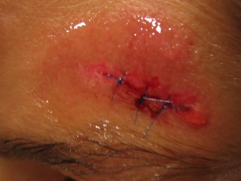1994 Ford Bronco - A stitched wound on skin shows blue sutures and metal staples, indicating medical attention.