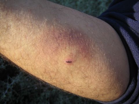 1990 Ford Bronco - Close-up of a person's hairy forearm showing reddish bruising and a small puncture wound, with grass behind.