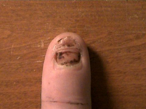 1977 Ford F-150 - My smashed finger
