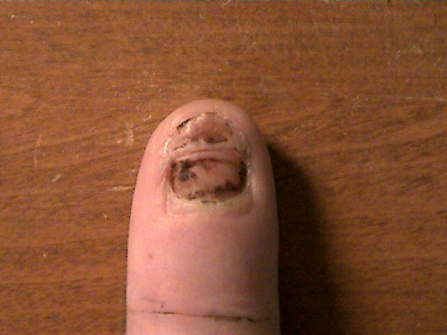 My smashed finger
