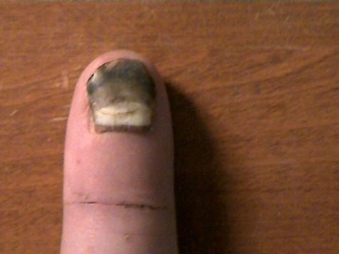 1977 Ford F-150 - my smashed finger with nail