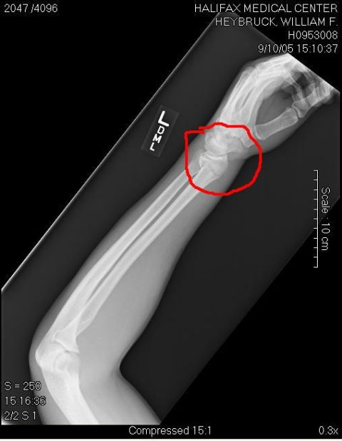 1989 Ford Bronco - X-ray of a human arm and wrist, showing bones and soft tissue. Medical information is visible on the image.