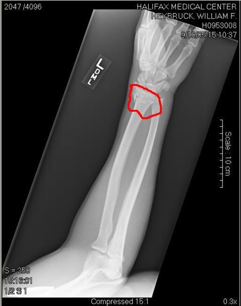 1989 Ford Bronco - Medical imaging shows a human wrist with a red outline highlighting the carpal bones.