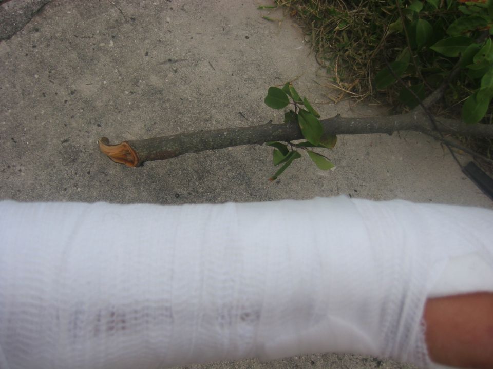 Casted arm on concrete with a tree branch and grass
