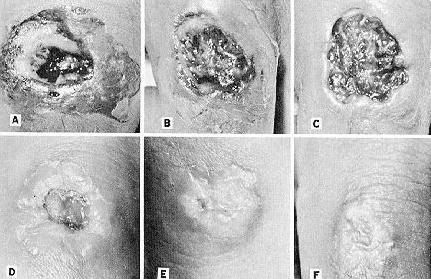 1990 Ford Bronco - Medical photos of skin lesions, not a vehicle technical document.