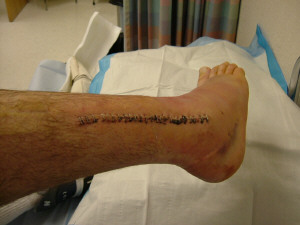 1993 Ford Bronco - A close-up view of a leg with surgical stitches, accompanied by a SuperMotors logo.