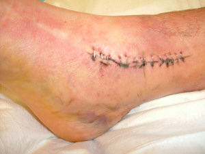 1993 Ford Bronco - A close-up view of a human leg showing surgical stitches and bruising, with a SuperMotors logo visible.
