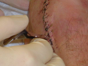 1993 Ford Bronco - A close-up view of a stitched wound, showing staples and the SuperMotors website logo.