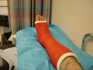 1993 Ford Bronco - A person's leg is encased in a vibrant orange cast, resting on a blue medical sheet.
