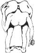 1989 Ford Bronco - This image depicts conjoined twins, a rare occurrence where individuals are physically attached.