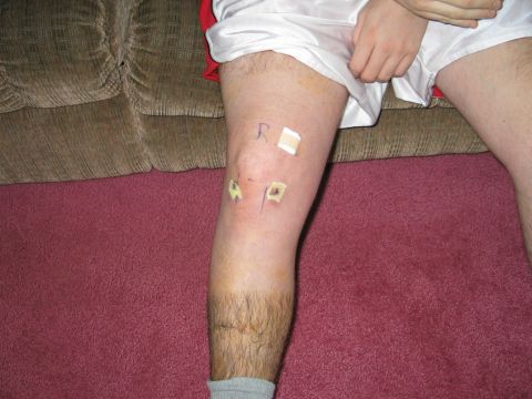 1995 Ford Bronco - A person's knee area is marked with tape and writing, likely for a medical procedure or tracking.