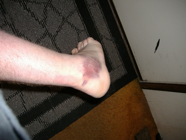 bruised ankle on a rug
