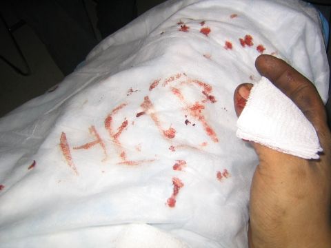 1978 Ford Bronco - A foot with a bloody toe wrapped in gauze, with text written in blood on a white cloth.
