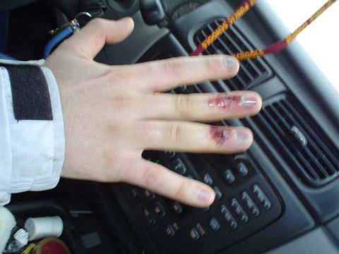 1981 Ford Bronco - A person's hand with visible injuries rests on the dashboard controls of a vehicle.