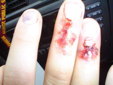 1981 Ford Bronco - Close-up of injured fingers in a vehicle, with visible dashboard buttons and a watermark.