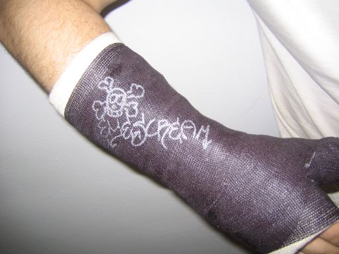 1978 Ford Bronco - An arm cast decorated with a skull and crossbones design and graffiti lettering.