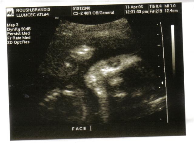 Ultrasound image with text 'FACE I' and medical data
