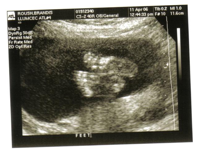 Ultrasound image showing fetal feet and body