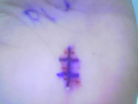 1990 Ford Bronco - A stitched wound on a palm with purple markings is visible.