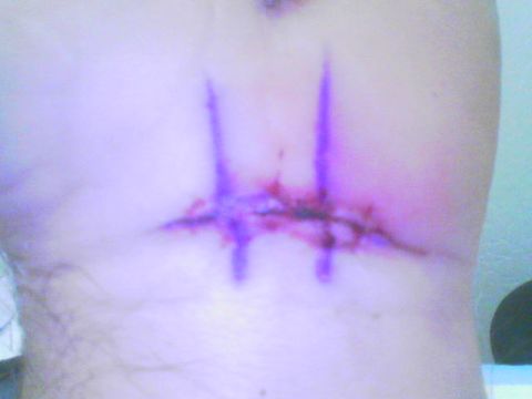 1990 Ford Bronco - A medical wound with sutures and purple ink markings is shown in detail.