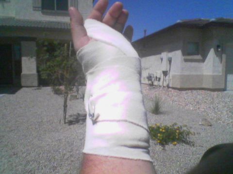 1990 Ford Bronco - A bandaged arm is held up in front of houses and a gravel yard under a clear blue sky.