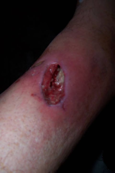 2003 Jeep TJ - Close-up of an infected wound on an arm, showing inflammation and tissue damage.