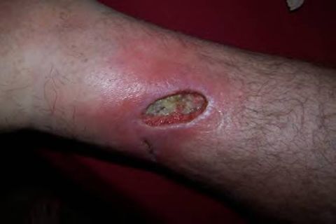 2003 Jeep TJ - The leg wound is inflamed and appears to have pus and necrotic tissue.