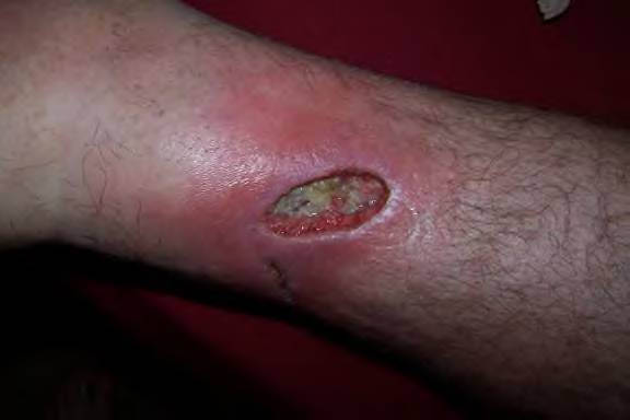 Close-up of an infected wound on a hairy leg, showing redness and pus