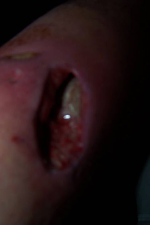 2003 Jeep TJ - A close-up view of a significant wound, showing exposed tissue and surrounding inflammation.